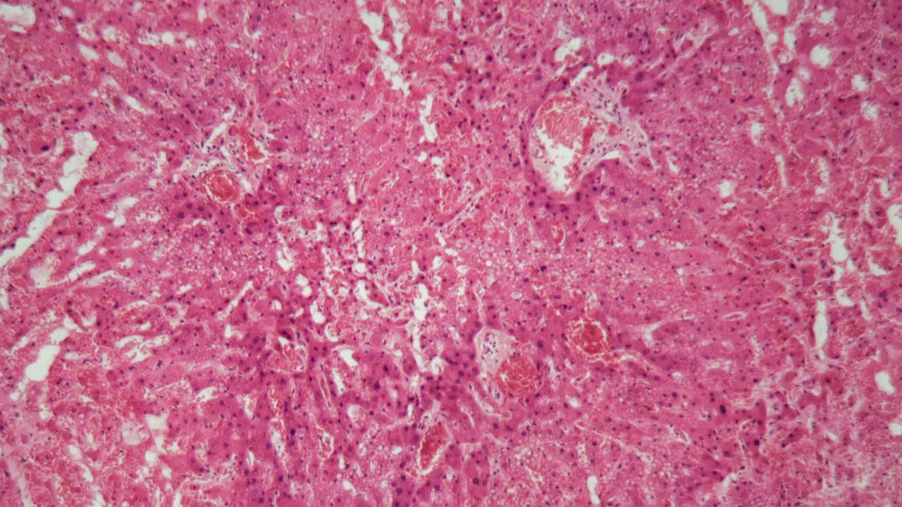 Journée mondiale de l'amylose : le 26 octobre 2023