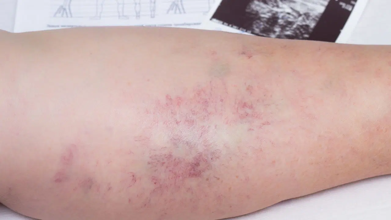 La journée mondiale de la thrombose : le 13 octobre 2023 La journée mondiale de la thrombose : le 13 octobre 2023