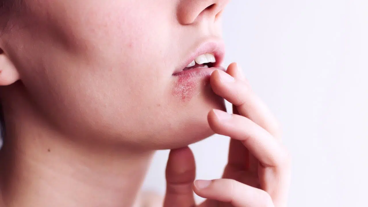 Journée nationale contre l'herpès : le 20 novembre 2023 Journée nationale contre l'herpès : le 20 novembre 2023