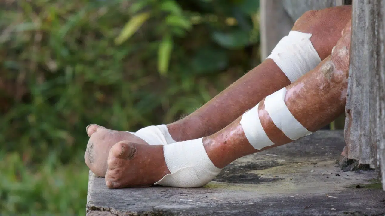 Journée mondiale des lépreux le 29 janvier 2024 Journée mondiale des lépreux le 29 janvier 2024