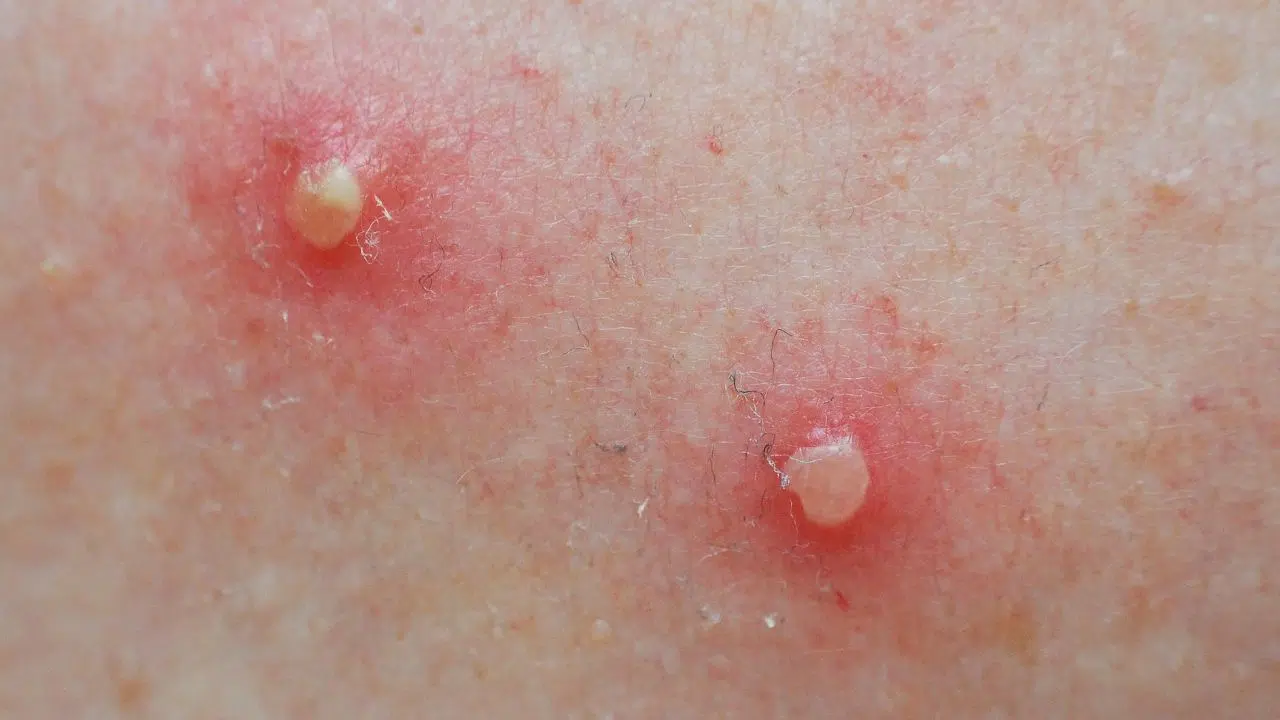 Alaskapox en Alaska un cas fatal alerte sur une possible expansion géographique Alaskapox en Alaska un cas fatal alerte sur une possible expansion géographique