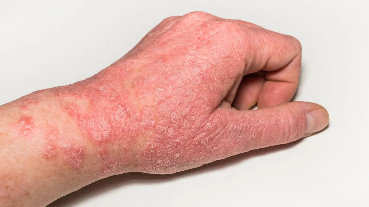 Amlitelimab une avancée prometteuse dans le traitement de la dermatite atopique Amlitelimab une avancée prometteuse dans le traitement de la dermatite atopique