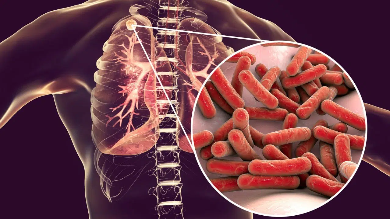 Journée Mondiale de Lutte contre la Tuberculose le 24 mars 2024 Journée Mondiale de Lutte contre la Tuberculose le 24 mars 2024