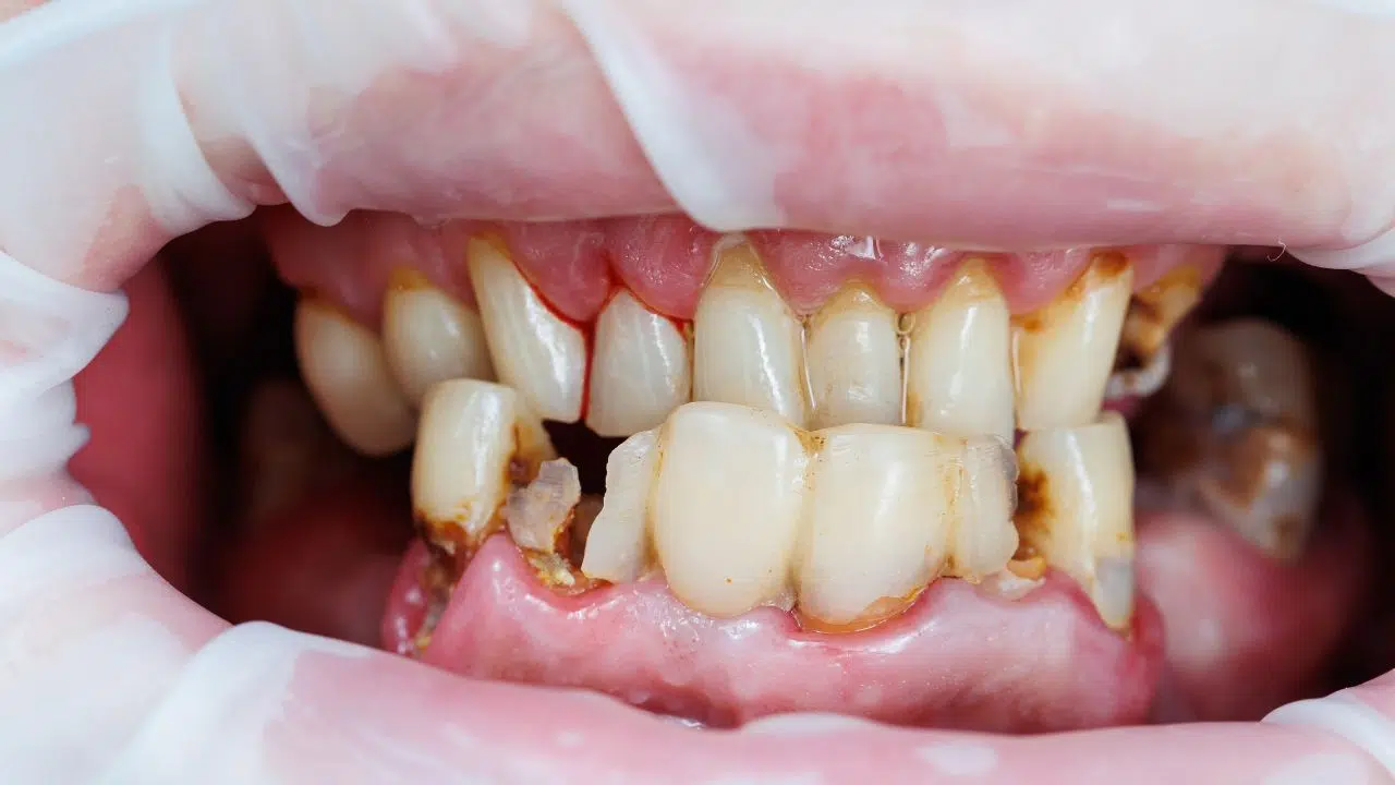 La journée mondiale de la santé bucco-dentaire le 20 mars 2024 La journée mondiale de la santé bucco-dentaire le 20 mars 2024