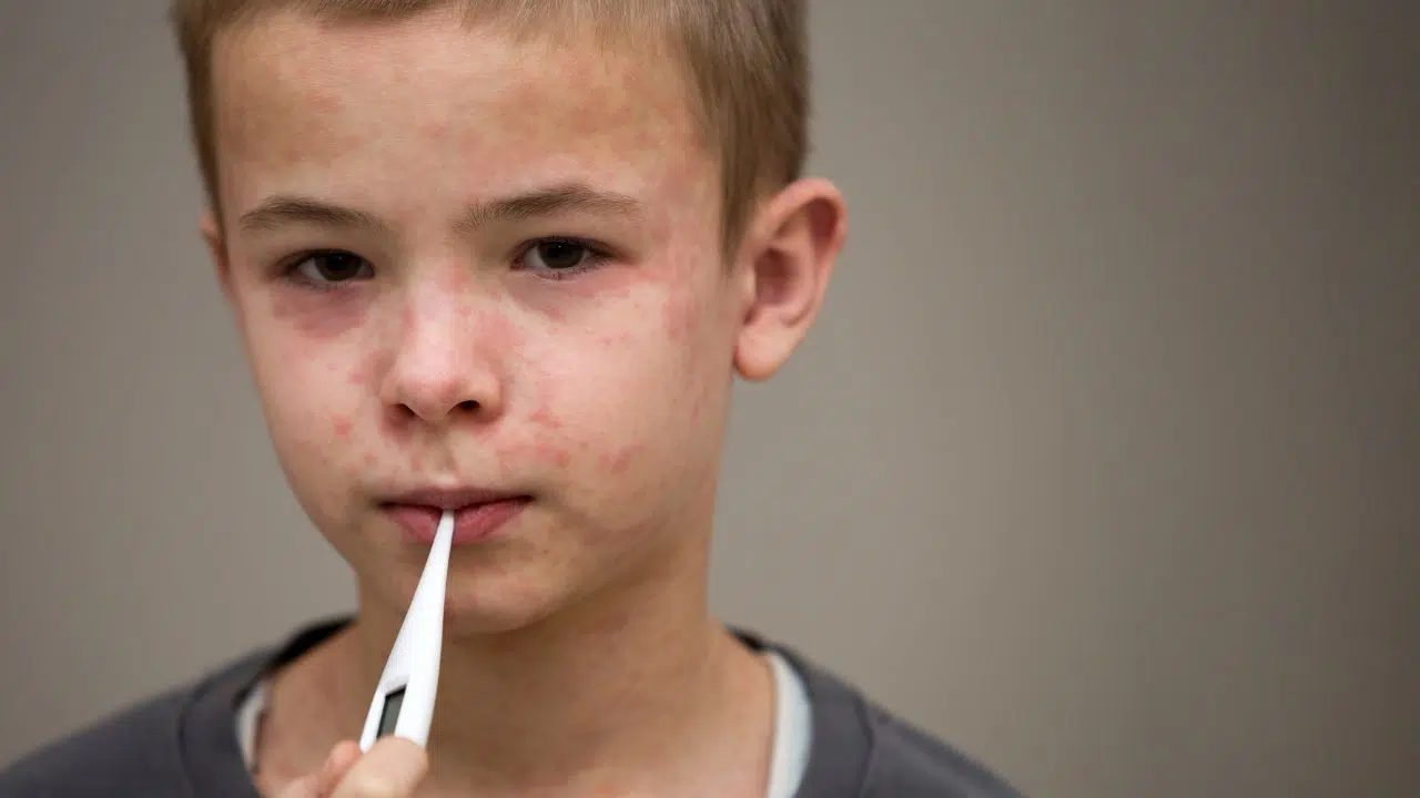 Pourquoi les États-Unis continuent-ils de connaître des épidémies de rougeole Pourquoi les États-Unis continuent-ils de connaître des épidémies de rougeole