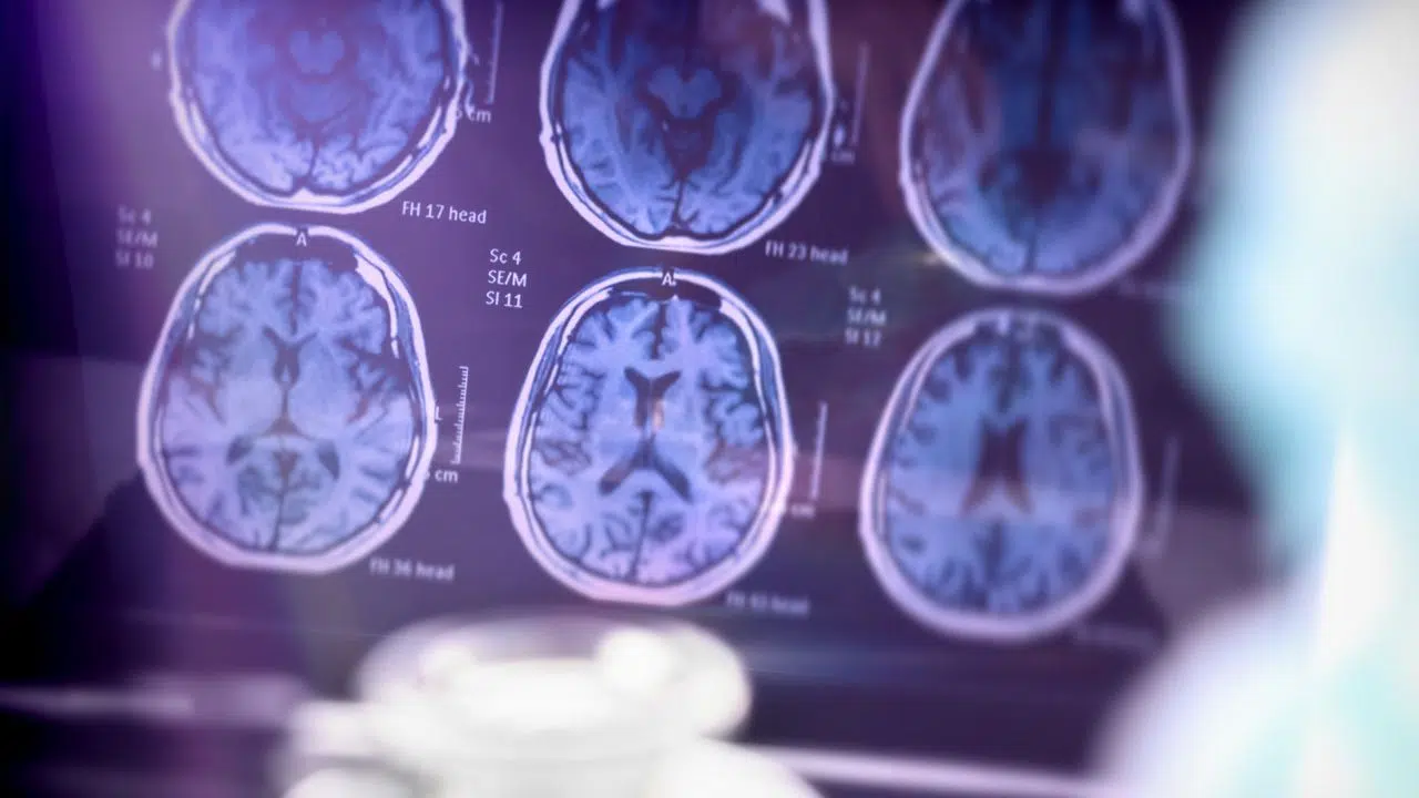 Protéines de type prion quels liens avec Alzheimer et d’autres maladies neurodégénératives Protéines de type prion quels liens avec Alzheimer et d’autres maladies neurodégénératives