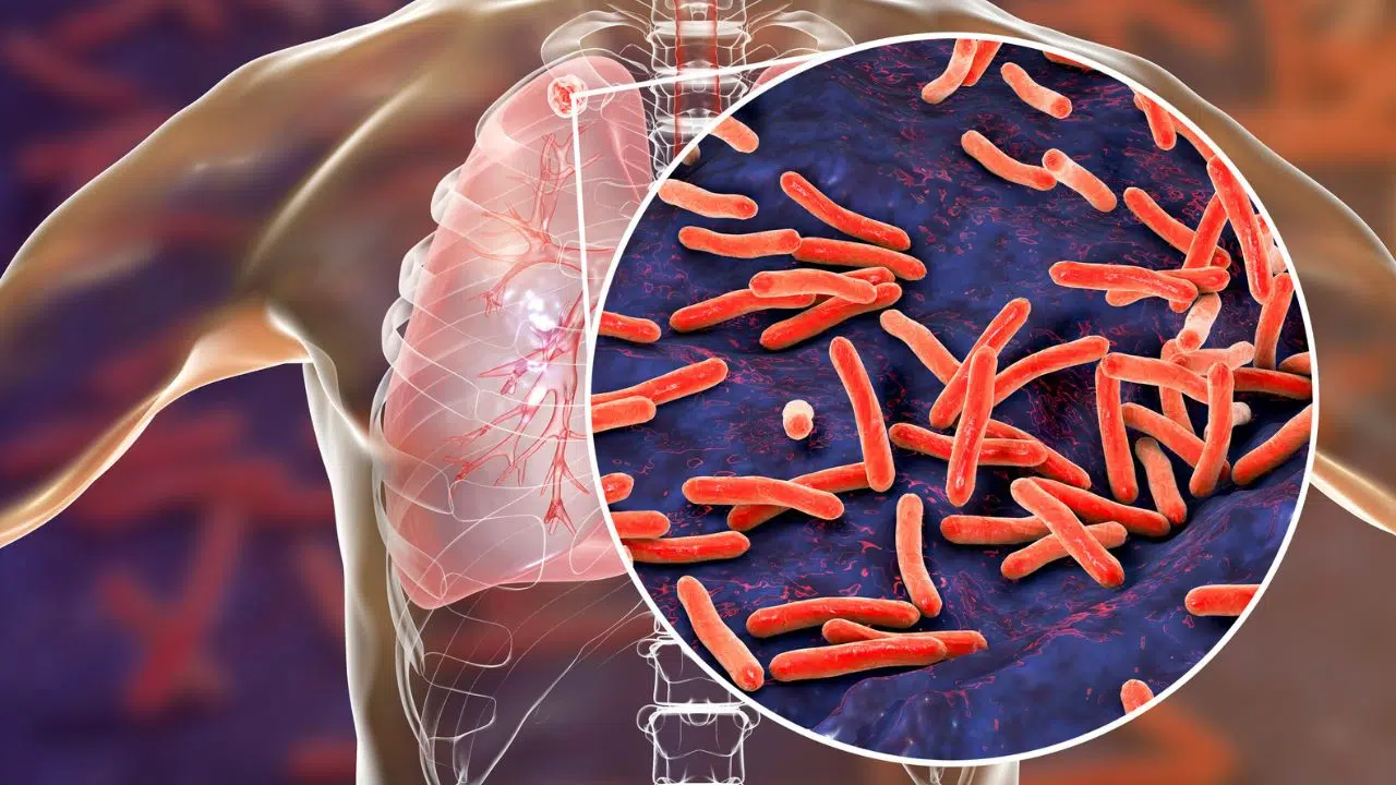 Tuberculose Vers de futurs biomarqueurs pour évaluer la contagiosité Tuberculose Vers de futurs biomarqueurs pour évaluer la contagiosité