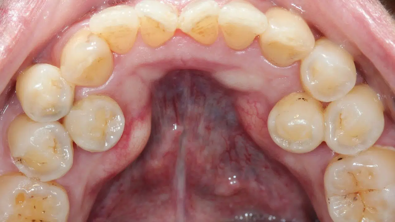 Dents Supernuméraires les raisons sont elles vraiment naturelles Dents Supernuméraires les raisons sont elles vraiment naturelles