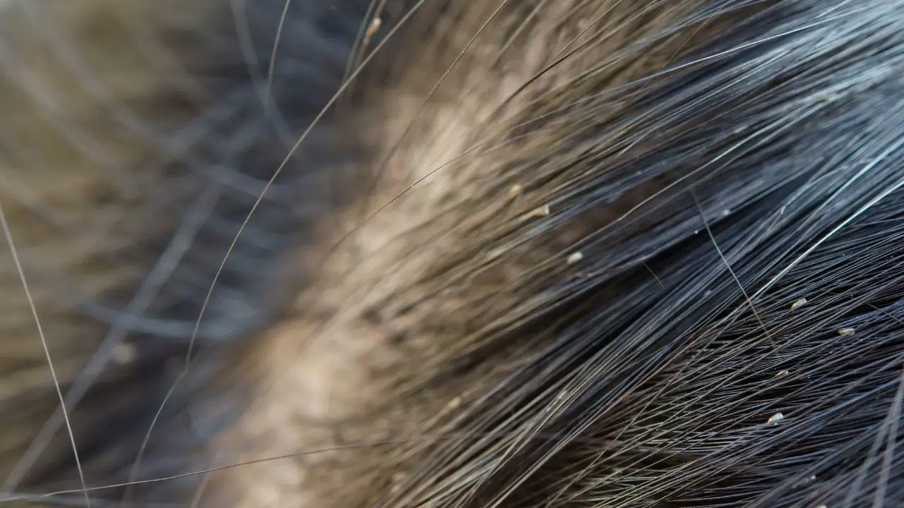 Nouvelle étude Le rôle crucial des poux dans la transmission de la peste Nouvelle étude Le rôle crucial des poux dans la transmission de la peste